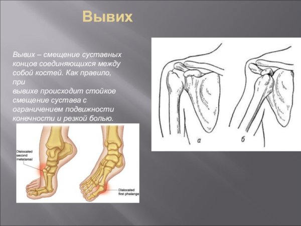 Дисплазия плечевого сустава