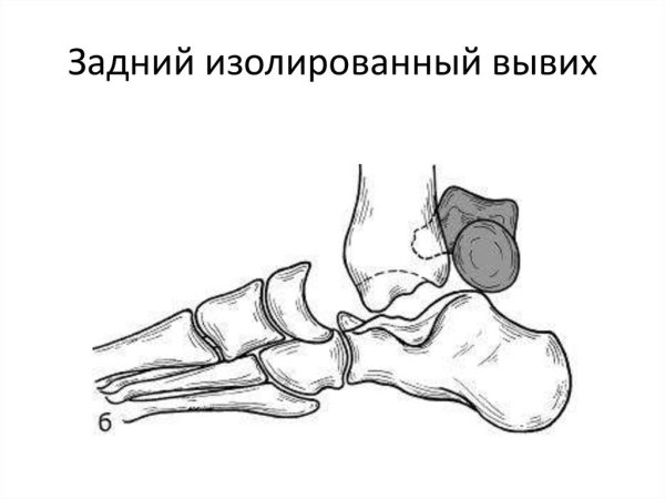 Вывих и подвывих в суставе