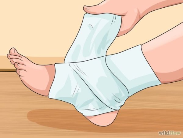 Растяжение вывих в колене