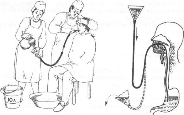 Промывание желудочного зонда алгоритм