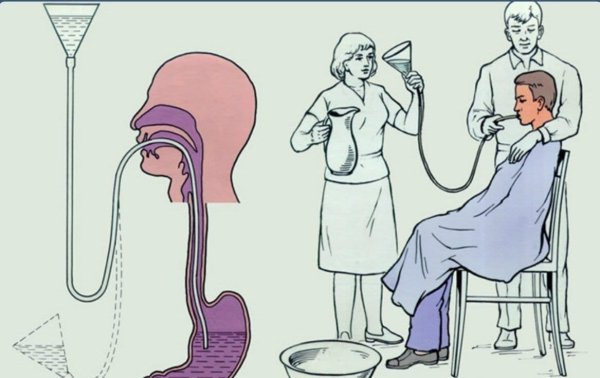 Зондовые манипуляции промывание желудка