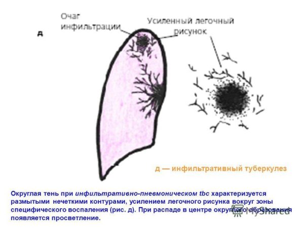 Усиленный легочный рисунок