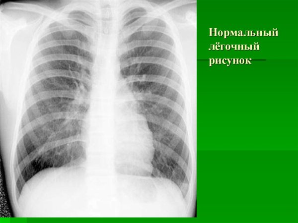 Нормальный легочный рисунок