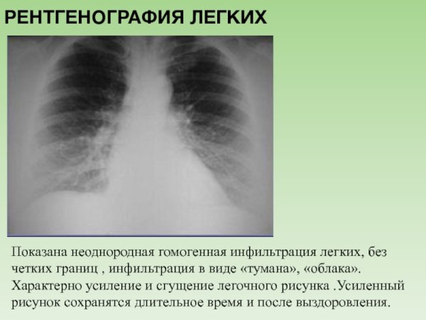 Рентгенография при хроническом бронхите описание