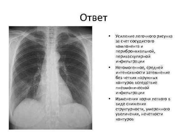 Сгущение легочного рисунка