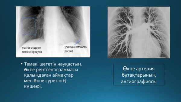 Усиление легочного рисунка за счет сосудистого компонента