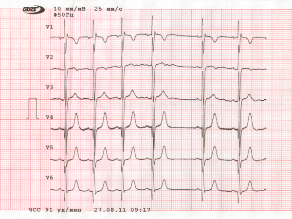 Кардиограмма сердца
