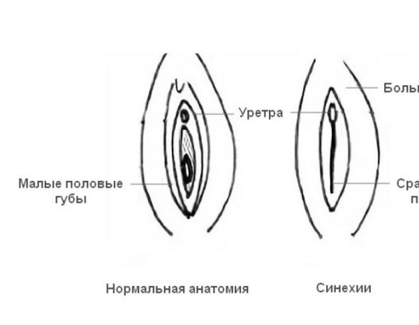 Сращения малых половых губ девушек