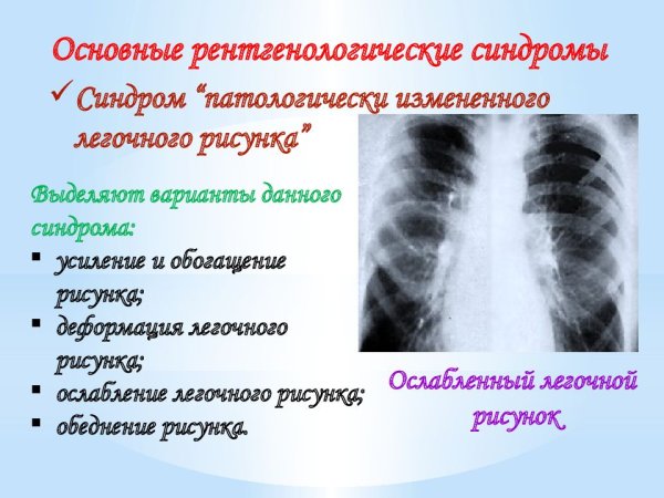 Легочный рисунок обогащен и деформирован