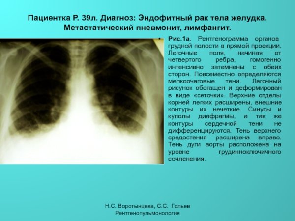 Легочный рисунок обогащен значительно тяжесть