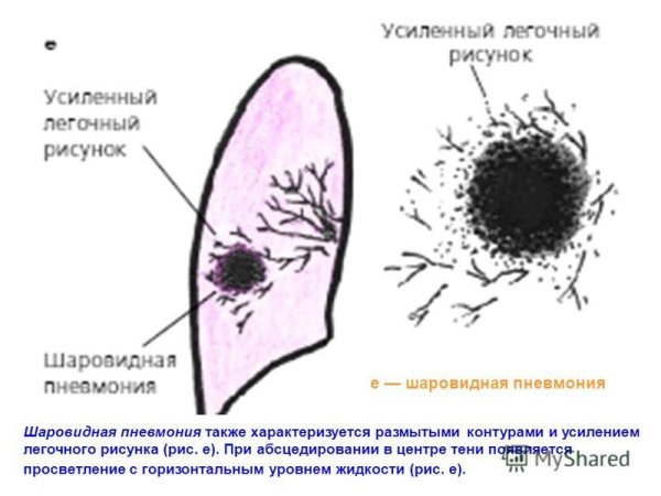 Шаровидная пневмония рентгенограмма