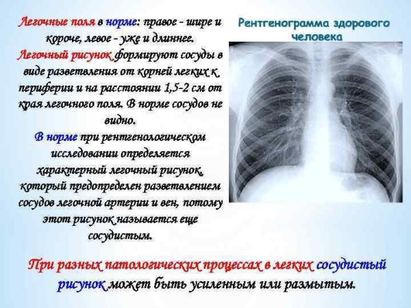 Легочный рисунок