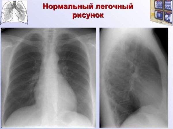 Прикорневая пневмония у детей рентген