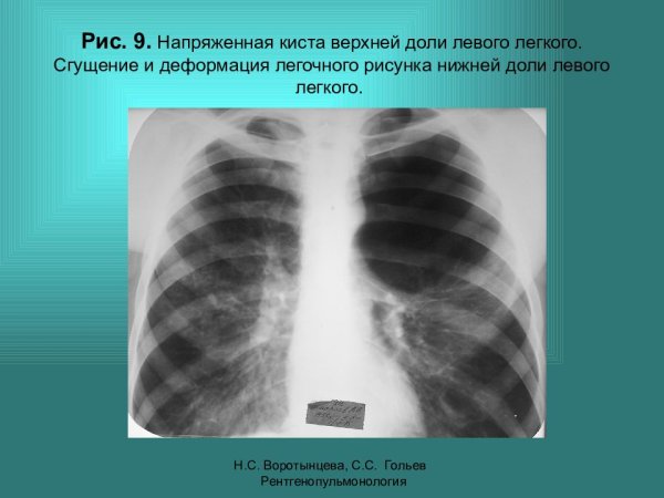 Легочный рисунок деформирован