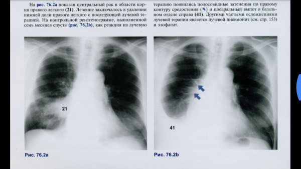 Сгущение легочного рисунка рентген