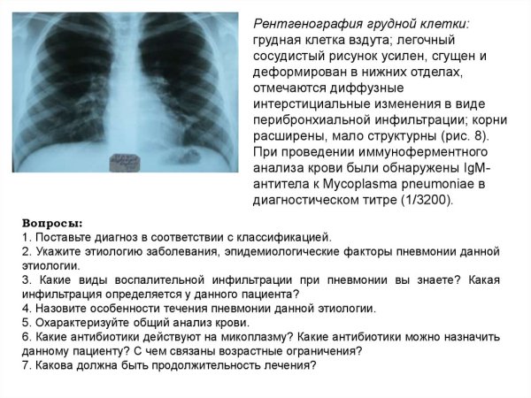Рентген области грудной клетки при пневмонии