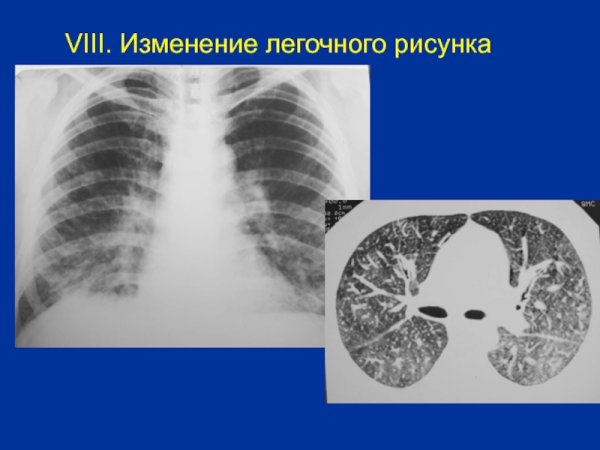 Патология легочного рисунка