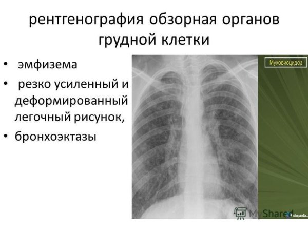 Диффузный сетчатый пневмосклероз