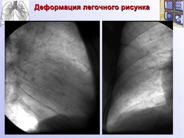 Синдром деформации легочного рисунка