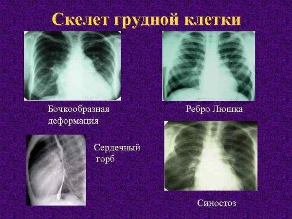Усиление и обогащение легочного рисунка