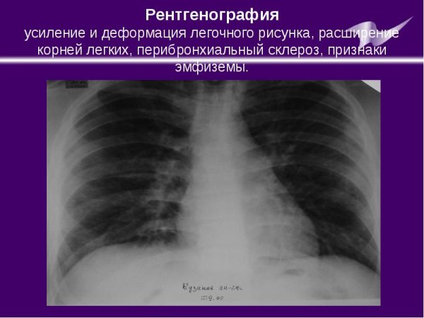 Сгущение легочного рисунка