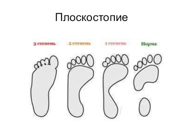 Плоскостопие доклад по биологии 8 класс