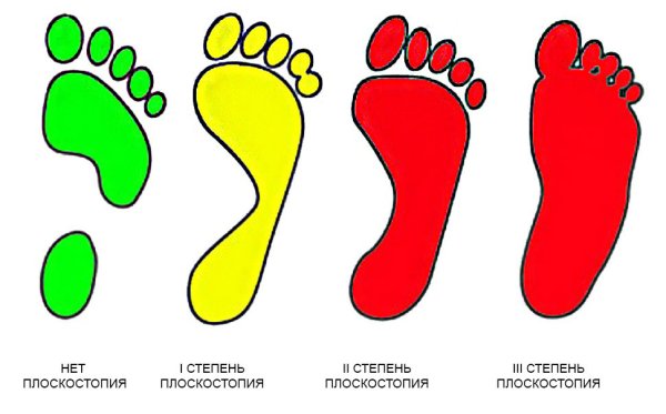 Степени плоскостопия 3 степени