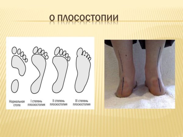 Плантография (по методу в.а.Яралова- Яралянца).