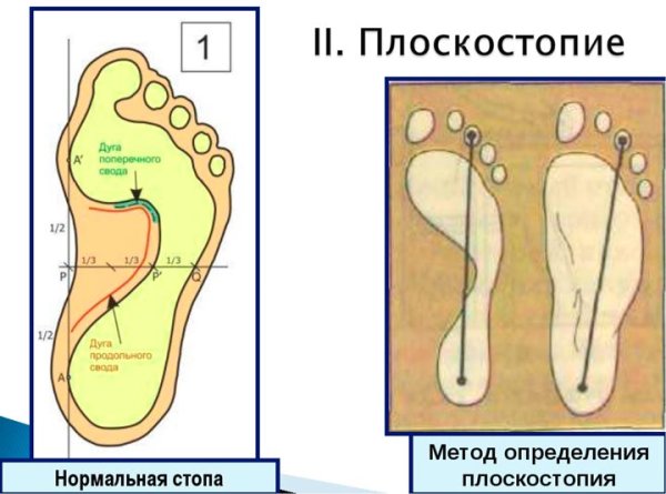 Отпечаток здоровой стопы