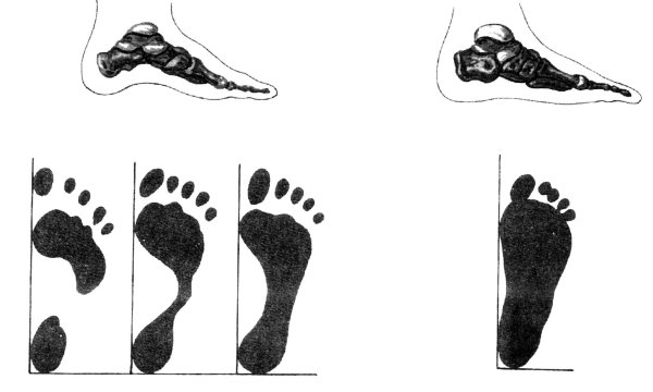 Нормальная стопа и плоскостопие