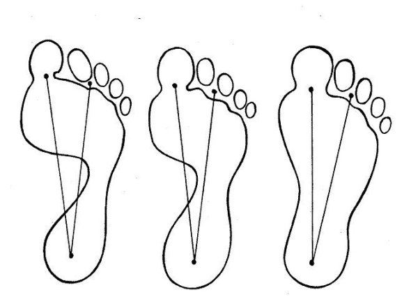 Первая степень плоскостопия