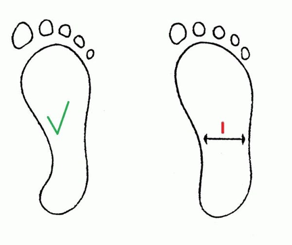 Как определяется плоскостопие
