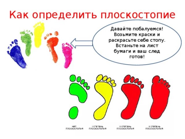 Плоскостопие норма и отклонение