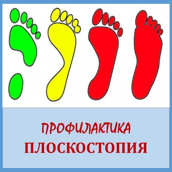 Плантограмма стопы у детей
