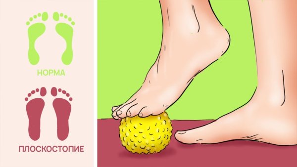 Выявление плоскостопия