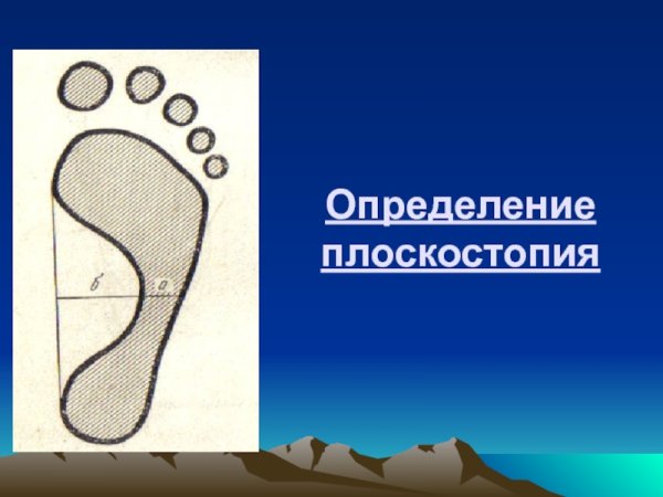 Осанка предупреждение плоскостопия