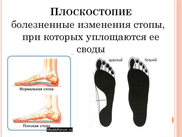 Поперечное плоскостопие отпечаток стопы