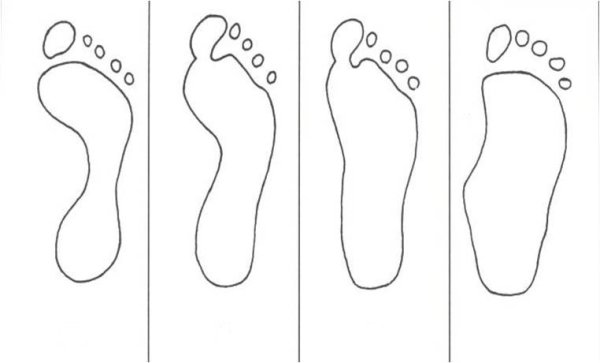 Оценка плантограммы по методу в.а. Яралова-Яраленда