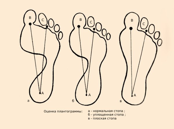 Выявление плоскостопия по отпечатку стопы