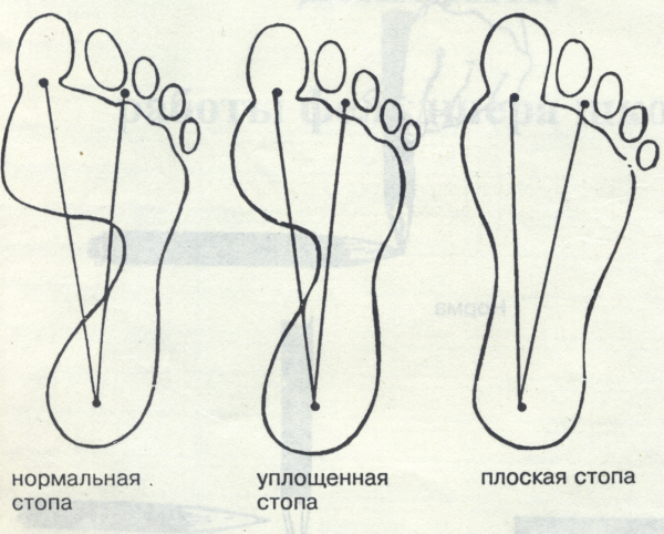 Стопа здорового человека и плоскостопие