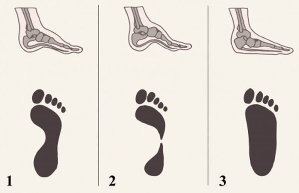 Симптомы плоскостопия у детей