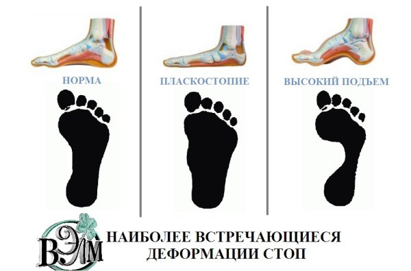 Стопа здорового человека и плоскостопие