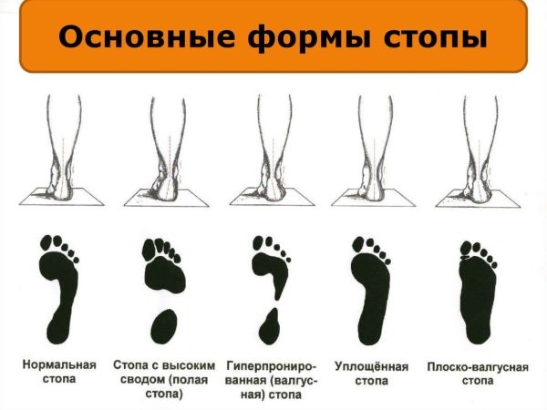 Отпечаток стопу у ребенка с плоскостопием 3 степени