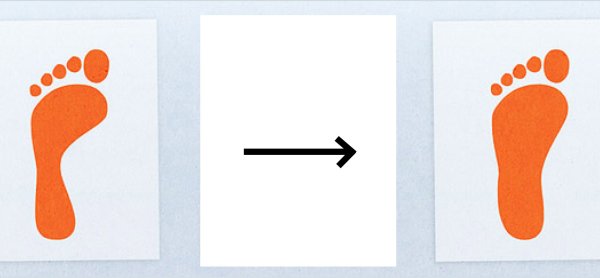 3 Я степень плоскостопия