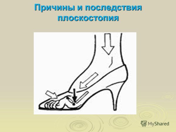 Продольно-поперечное плоскостопие и вальгус 3 степени