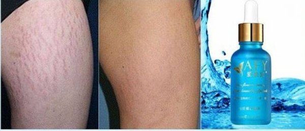 Кокосовое масло от растяжек до и после