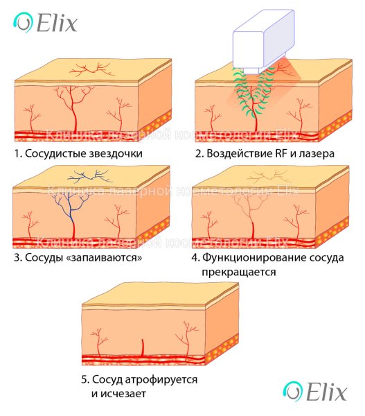 Сосудистые звездочки на ногах лазер