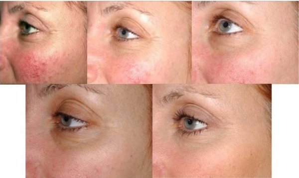 Телеангиоэктазии розацеа