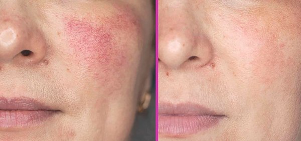 Эндотелий сосудов анатомия