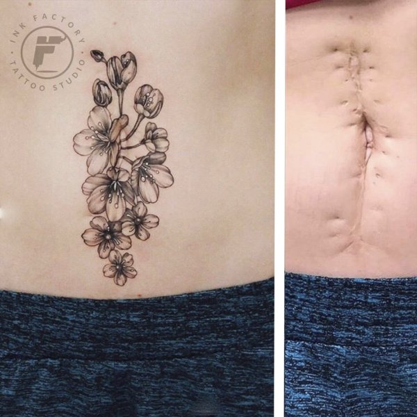 Перекрытие шрамов татуировкой